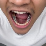 does any one else still have a mouth full of silver.jpeg