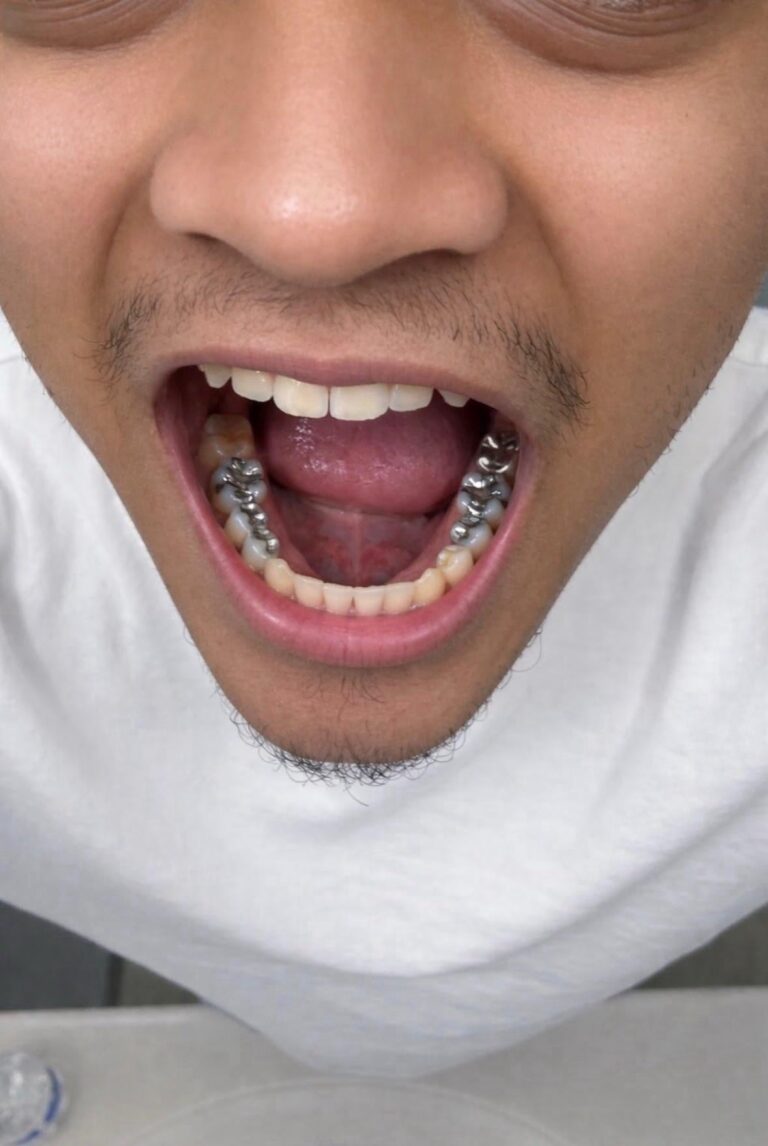 does any one else still have a mouth full of silver.jpeg
