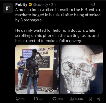 a man in india walked himself to the er with a machete lodged in his skull.png